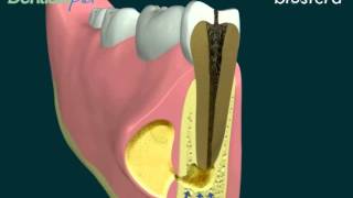 Ascesso la terapia endodontica [upl. by Aydne]