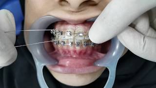 Orthodontic Ligation [upl. by O'Mahony]