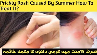 Skin Rash Caused By Summer How To Treat Prickly Rash [upl. by Kial790]