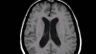 Vestibular Schwannoma  MRI [upl. by Anaeirb]