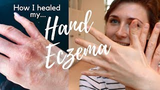 Hand Eczema Treatment Natural Cure  7 Tips How I Healed My Hand ECZEMA  HEAL ECZEMA NATURALLY [upl. by Oidivo830]