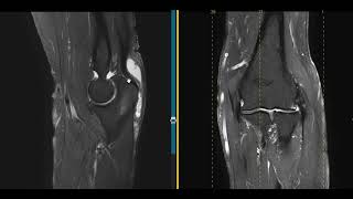 Elbow pain from olecranon bursitis [upl. by Battista]