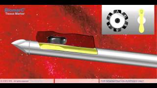 STEREOTACTIC VACUUM BIOPSY VAB [upl. by Kristen897]