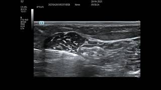 Paediatric popliteal block [upl. by Horatia]