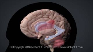 Intracerebral Hemorrhage Stroke [upl. by Eladal495]