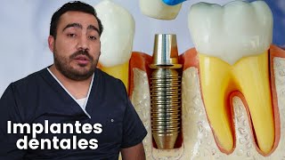 Todo sobre Implantes dentalesCuanto cuesta un implante dental [upl. by Imaj403]