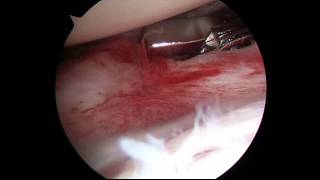 Frozen shoulder arthroscopic release [upl. by Otineb]