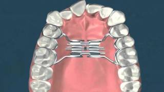 Expasion palatina rapida  Ortodoncia [upl. by Ciredor]