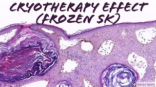 Cryotherapy Effect in a Seborrheic Keratosis Frozen SK [upl. by Kovar]