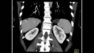 Abdomen Liver Hemangioma of the Liver7 of 8 [upl. by Valery]