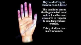 Raynauds Fingers Phenomenon classic  Everything You Need To Know  Dr Nabil Ebraheim [upl. by Alonzo247]