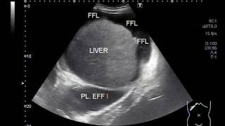 Ultrasound Video showing ascitic fluid and pleural fluid [upl. by Malinda475]