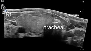 UltrasoundGuided FNAC in PostHemithyroidectomy with Multinodular Goiter Imaging Findings [upl. by Cochran]