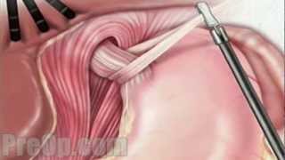 Hernia Hiatal Laparoscopic Surgery PreOp® Patient Education [upl. by Weikert]