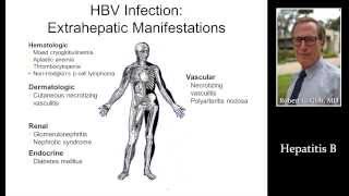 HEPATITIS B HBV by Dr Robert Gish [upl. by Aldwon]