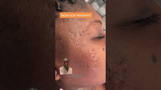 How I treat atrophic acne scars in black skin aestheticmedicine blackskincare [upl. by Lenora]