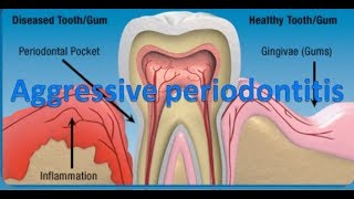 Aggressive periodontitis [upl. by O'Shee]