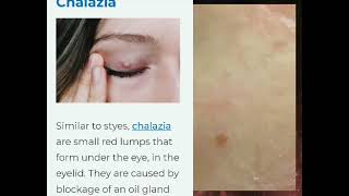 eyelid wart remóval milia face eyelid removal beforeafterresult [upl. by Neerahs]