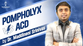 Pompholyx Vs ACD by Dr Maddineni Srinivas  Cerebellum Academy [upl. by Ardnekan935]