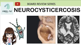 Neurocysticercosis CTMRI board review [upl. by Dnalhsa]