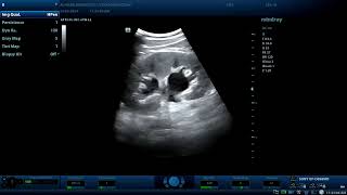 Several different cases of ureteric and UVJ detected stones  Diagnostic ultrasound cases [upl. by Davidoff]