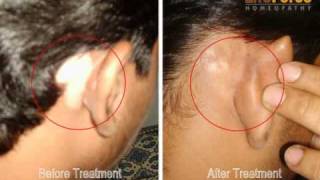 Vitiligo on Face Behind Ears Treated by Dr Rajesh Shah [upl. by Gowon]