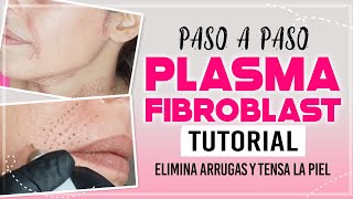 PLASMA PEN FIBROBLAST paso a paso  Rostro cuello doble mentón  plasma pen CarolinaSKB plasmapen [upl. by Beitch]