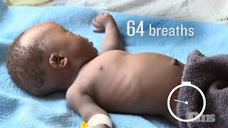 How to count respiration rate and notice chest indrawing in children [upl. by Meris]