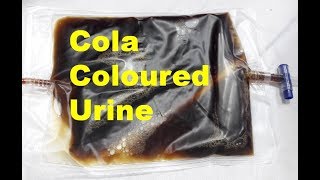 Cola Coloured Urine [upl. by Kapor]