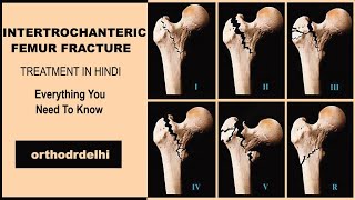 INTERTROCHANTRIC FRACTURE FEMUR IN HINDI proximal femur fractures IN HINDI [upl. by Lela]