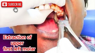 Extraction of tooth  Tooth extraction  Tooth removal procedure  drhirenpatelvlo [upl. by Lamok]