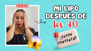 Mi experiencia lipoescultura después de los 40 años [upl. by Cr561]