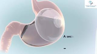 Elipse Intragastric Balloon Animation Video [upl. by Conan11]