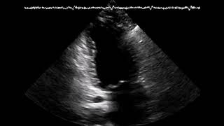 Cardiotoxicity from chemotherapy cardiooncology An echocardiography case and discussion [upl. by Caine]