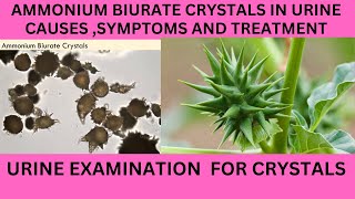 AMMONIUM BIURATE CRYSTALS IN URINECAUSES SYMPTOMS AND TREATMENT OF AMMONIUM BIURATE [upl. by Eissalc]