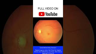 Central Retinal Artery Occlusion Fundoscopy shorts [upl. by Boykins134]