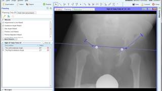 Developmental Dysplasia of the Infant Hip  DDH  Materialise OrthoView [upl. by Rhys679]