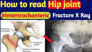 Hip Fracture Repair with 67 mm Cannulated Screws [upl. by Pliner]