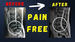 L4 L5  L5 S1 disc herniation recovered pain free without surgery [upl. by Anaihs]