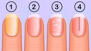 5 Things Your Nails Can Tell You About Your Health [upl. by Allys128]