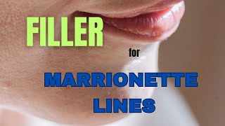 FILLER for MARIONETTE LINES  injection technique revealed [upl. by Femi]