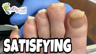 TWO INCH LONG TOENAILS TRIMMED SO SATISFYING AND SOOTHING TO WATCH [upl. by Eked40]