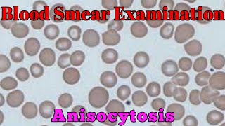 Blood Smear Examination Anisocytosis Macrocytic and Microcytic blood cells blood smear Lecture 2 [upl. by Melissa]