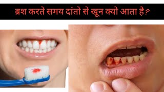 why are my gums bleeding  Causes symptoms and treatment options Oralhealthconscious [upl. by Keyser]