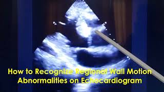 How to Recognize Regional Wall Motion Abnormalities on Echocardiogram [upl. by Fosque929]