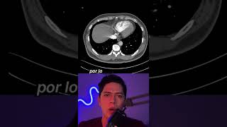 Diagnóstico Radiológico de Tromboembolia Pulmonar Un Caso Clínico [upl. by Nevear]