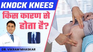 Knock Knees किस कारण से होता है  Knock Knee Problem  Vikram Mhaskar [upl. by Ynavoeg235]