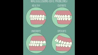 Different Types of Malocclusions [upl. by Edlin]