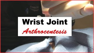 Wrist Joint Arthrocentesis Procedure [upl. by Giefer790]