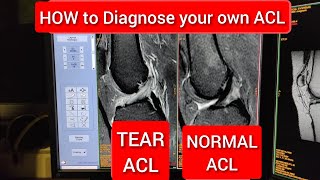 How to Diagnose your Own ACL Tear Anatomy on MRI [upl. by Ainotahs]